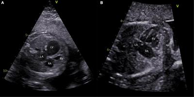 Hypoplastic Left Heart Syndrome: Is There a Role for Fetal Therapy?